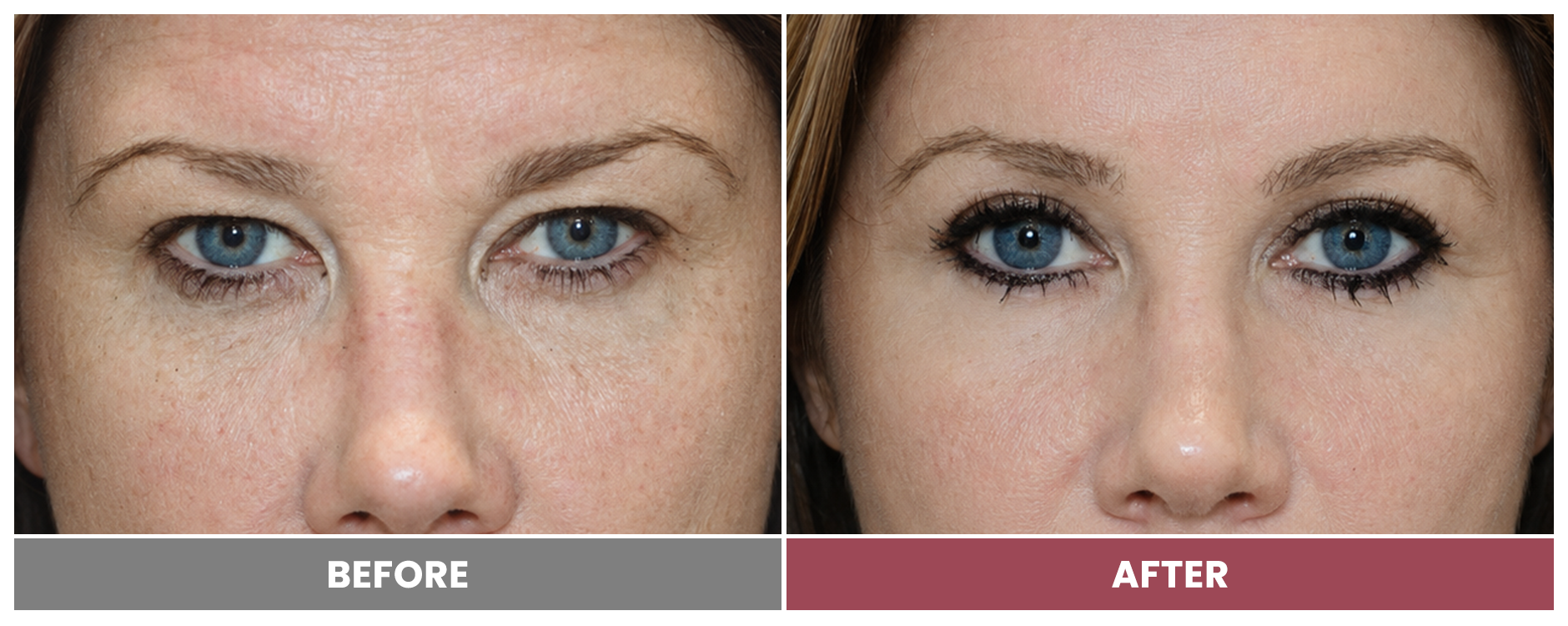 Upper Blepharoplasty - Case 48